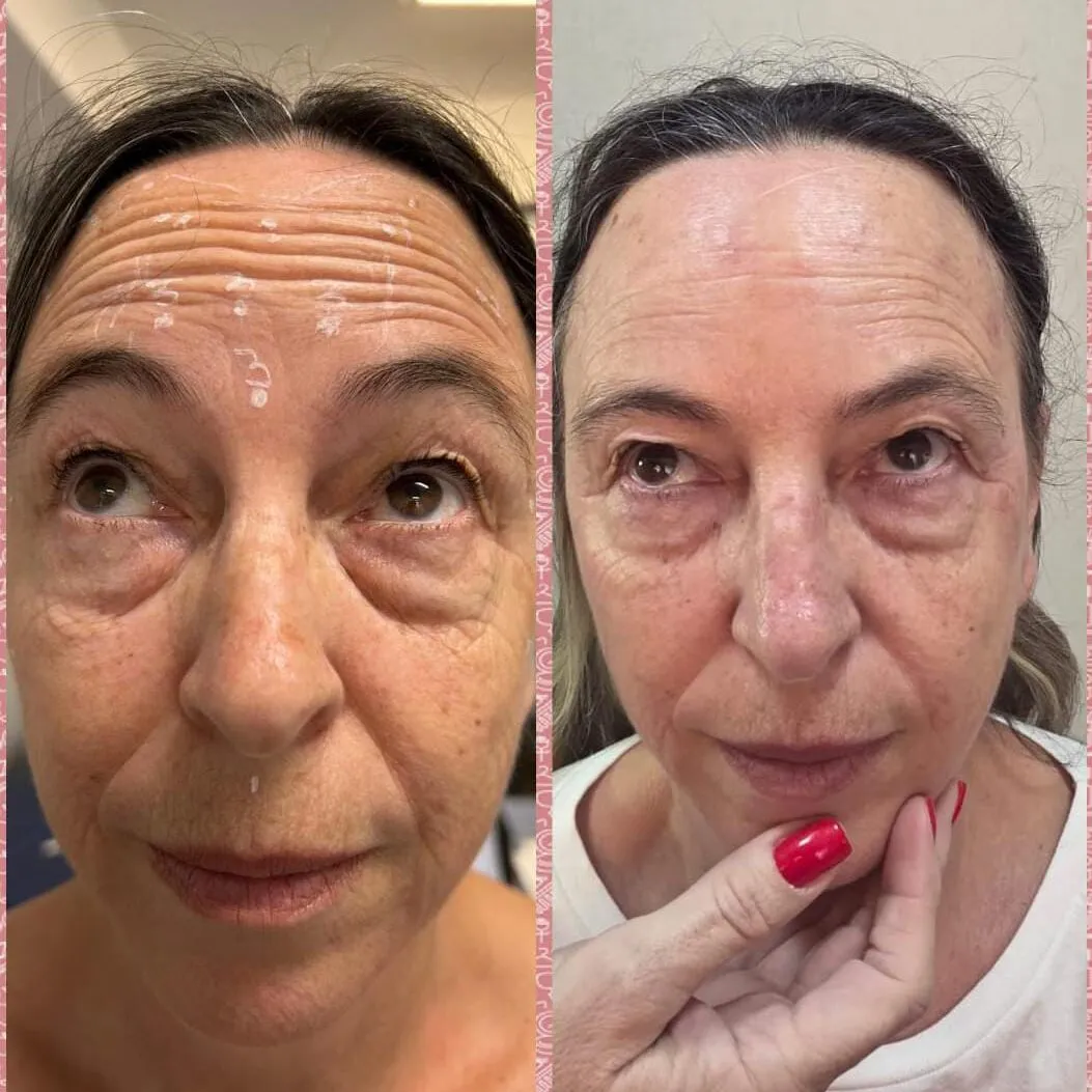 Antes e depois da aplicação de toxina botulínica em paciente modelo do curso